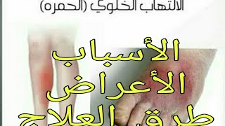 الالتهاب الخلويالحمره Cellulitis الاسباب،الاعراض،العلاج [upl. by Rob21]