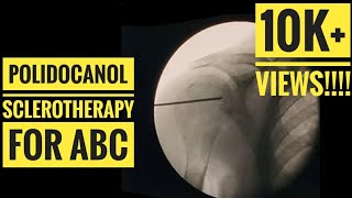 Polidocanol Sclerotherapy for Aneurysmal Bone Cyst [upl. by Einegue509]