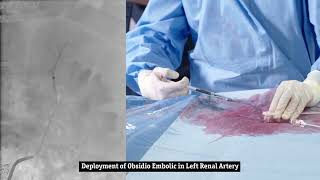 Pre Clinical Embolization Procedure with Obsidio [upl. by Nelsen]