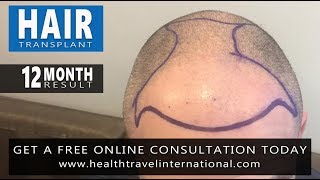 FUE Hair Transplant  12 Month Result  Hairline Restoration  Hair Loss Before amp After [upl. by Dunc]