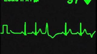 Multifocal Premature Ventricular Contractions PVCs [upl. by Norbel891]