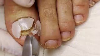 Fungal Nail with Dried Abscess 🦶 Ingrown Nail Treatment 🦶 Thick Fungal Toenail [upl. by Mala250]