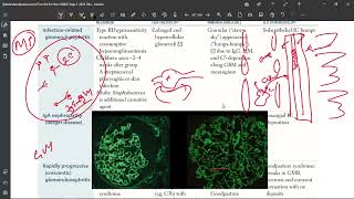 Infection Related glomerulonephritis  Post Streptococcal Glomerulonephritis PSGN [upl. by Ronnie]