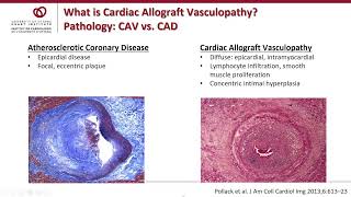 Cardiac Allograft Vasculopathy CAV  Weekly Research Conference with Sharon Chih MD PhD [upl. by Wachter]