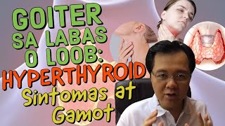 Goiter sa Labas o Loob Hyperthyroid Sintomas at Gamot  Payo ni Doc Willie Ong 212 [upl. by Aryl632]