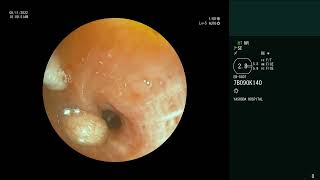 Endobronchial Carcinoid  Tumor debulking  Electrosurgical snaring  Cryoextraction [upl. by Ugo]