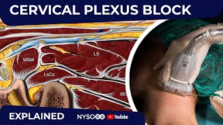 Cervical Plexus Block  Regional anesthesia Crash course with Dr Hadzic [upl. by Adnama]