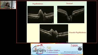 KSOS2023 Dr Rehna Rasheed FP214 Papilledema Vs Pseudopapilledema A Qualitative analysis of swo [upl. by Lletnahc531]