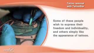 Tattoo removal with the TattooStar qswitched laser by Asclepion [upl. by Yetsirhc232]