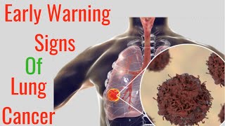 Early Warning Signs of Lung Cancer [upl. by Snebur]