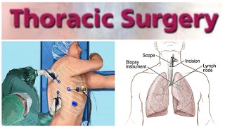 Thoracic Surgery 1  Bronchogenic Carcinoma [upl. by Ardnoed]