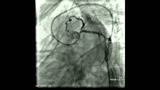 Procedura Angiografia coronarica [upl. by Leupold]