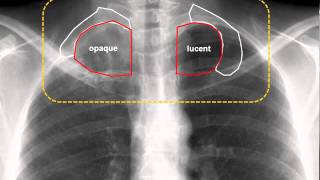 Pancoast Tumor amp Horner Syndrome [upl. by Emlin]