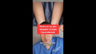 Dermatologist explains Idiopathic Guttate Hypomelanosis White arm spots derm skin todayIlearned [upl. by Lang688]