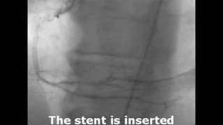 What A Diffenence A Stent Makes [upl. by Wolfgram]