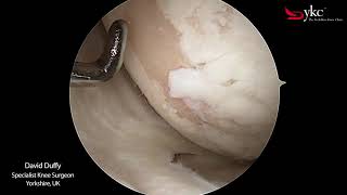 What Does Arthritis of The Knee Joint Look Like [upl. by Reace512]