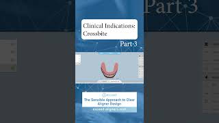 Clinical Indications Crossbite Part 3 [upl. by Peednam]