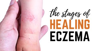 Natural Eczema Treatment  The Stages of Healing Eczema [upl. by Sarina930]