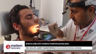 Burun Ameliyatı Sonrası Tampon ÇıkarılmasıYrd Doc Dr Ahmet Hamdi Kepekçi [upl. by Gardner436]