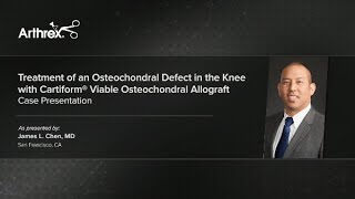 Treatment of an Osteochondral Defect in the Knee with Cartiform® Viable Osteochondral Allograft [upl. by Atnoled317]