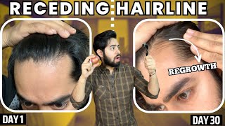 सिर्फ 1 महीने मैं RECEDING HAIRLINE REGROW करो  30 days HAIRLINE REGROWTH challenge [upl. by Reifinnej]