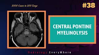 CENTRAL PONTINE MYELINOLYSIS Radiology Tutorials 1000 videos in 100 days video 38 [upl. by Einniw374]