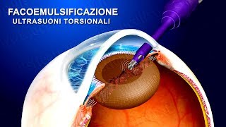 Cataratta terapia chirurgica con ultrasuoni torsionali wwwoculisticaTVit [upl. by Ameerak]