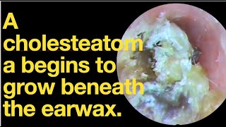 A cholesteatoma begins to grow beneath the earwaxear wax removal  ear cleaning  ASMR  relax [upl. by Broder626]