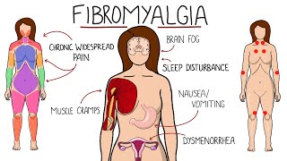 Fibromyalgia  A Chronic Pain Disorder Includes Symptoms Criteria amp Treatment Options [upl. by Hillhouse]