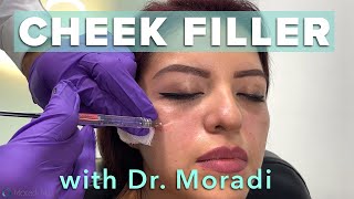 Watch This Patient Get Cheek Filler Before amp After Restylane Contour [upl. by Drobman]