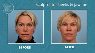 Sculptra filler for cheeks and jawline [upl. by Aicilehp349]