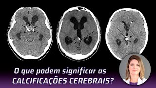 O QUE PODEM SIGNIFICAR AS CALCIFICAÇÕES CEREBRAIS [upl. by Adnomal]