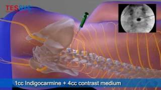 Treatment of herniated disc with TESSYS method lateral  BandscheibenOP mit TESSYSMethode lateral [upl. by Perreault]