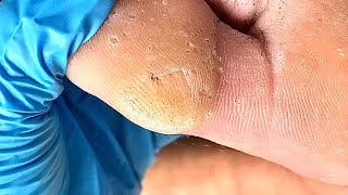 Callus removal from feetampFoot scraping dead skin【Xiao Yan pedicure】stress 4 [upl. by Grete]