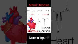 Normal Heart sounds and murmur Auscultation mitral valve stenosis murmur of heart in diastole [upl. by Rabbi]