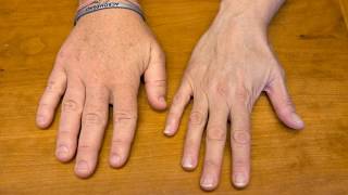 Difference Between Gigantism and Acromegaly [upl. by Nikolas777]