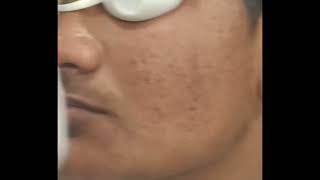 Comedones Removal Pimple treatment by Dr Paras Panot Dermatologist [upl. by Toby114]