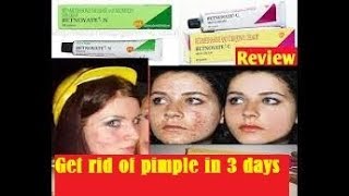 Betnovate cream Review in Tamil  uses  side effectsget rid of pimples in 3 days [upl. by Bozovich]