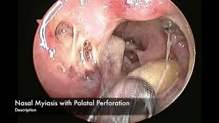 Nasal Myiasis with Palatal Perforation Maggots in Nose [upl. by Turner]