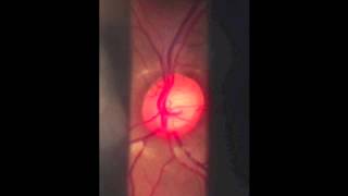 Indirect Ophthalmoscopy final [upl. by Williamson]