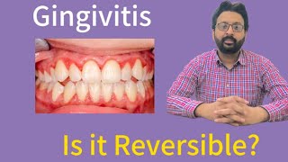 Gingivitis A Gum Disease  Can It Be Reversed  AteeqDentalCareEnglish [upl. by Penthea]