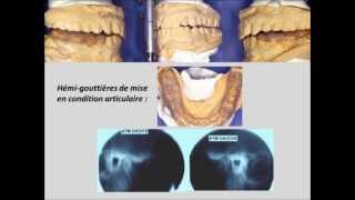 OrthodontieOcclusodontieFin de traitement version intégrale [upl. by Kirst]