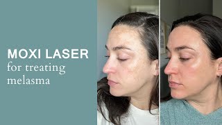 MOXI LASER FOR MELASMA [upl. by Llevram]