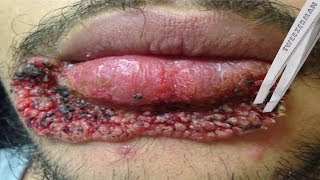 Worst Lip Pimples on YouTube [upl. by Anwahsal163]