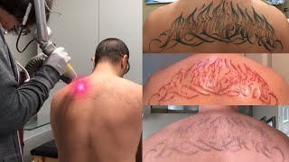 Laser Tattoo Removal  The Ugly Truth [upl. by Lida36]