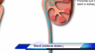 CATETER DOBLE J O STENT URETERAL [upl. by Enhpad]