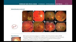 Retinal disorders  Neurology  33  First Aid USMLE in UrduHindi [upl. by Rogerg975]