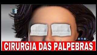 CIRURGIA DAS PÁLPEBRAS  Tudo que você precisa saber  Cirurgia Plástica [upl. by Joachim]