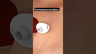 🫁tracheostomy procedure nursing🫁 youtube shorts short trending ytshorts norcetmcq trend [upl. by Bor110]