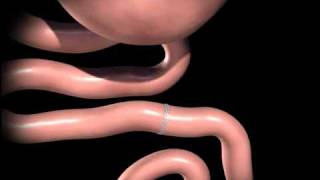 RouxenY gastric bypass animation from wwwhawaiiweightlosscommp4 [upl. by Genia]